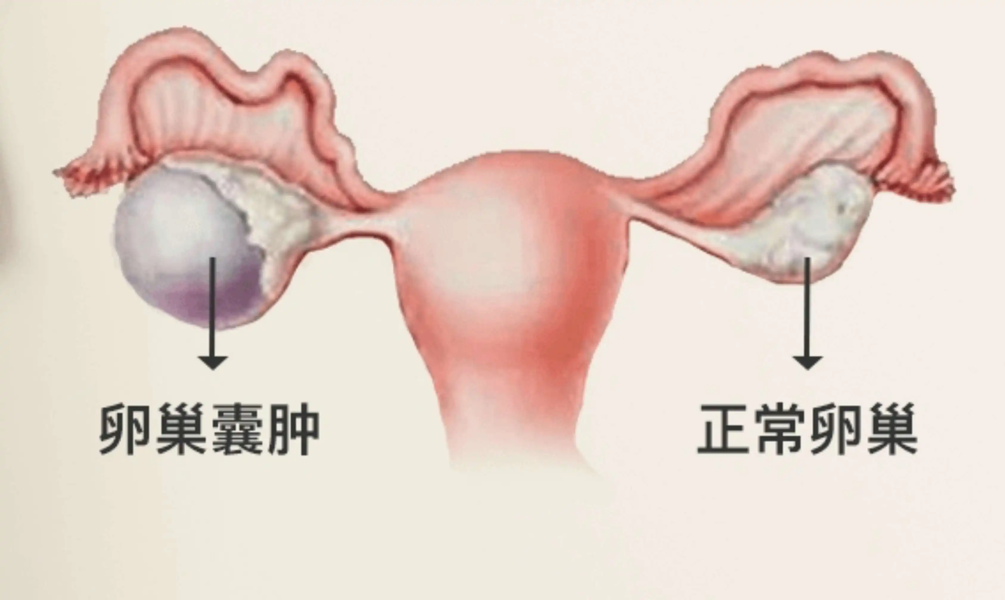 深圳卵巢囊肿会影响试管吗