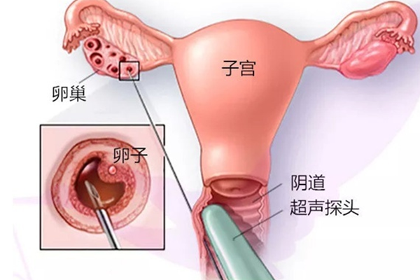 取卵过程痛不痛?