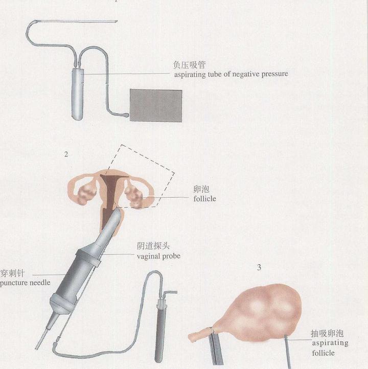 取卵后要注意什么？